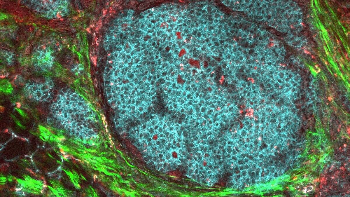 Turning a tumor’s ‘shield’ into a weapon against itself
