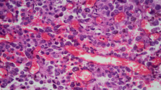 lung tissue adenocarcinoma as seen under a microscope.